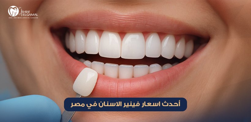 اسعار فينير الاسنان