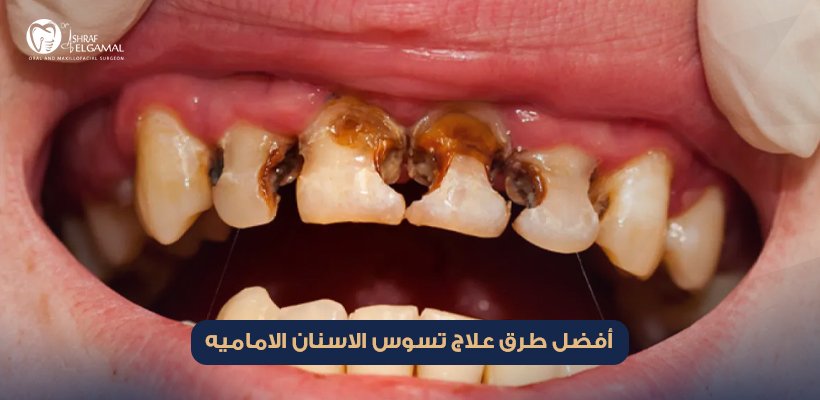 تسوس الاسنان الاماميه