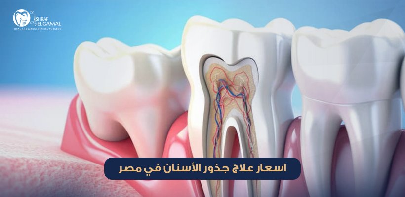 اسعار علاج جذور الأسنان