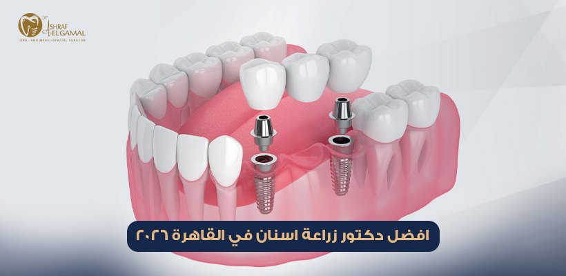 افضل دكتور زراعة اسنان في القاهرة