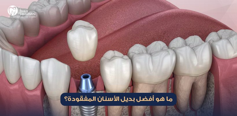بديل الأسنان المفقودة
