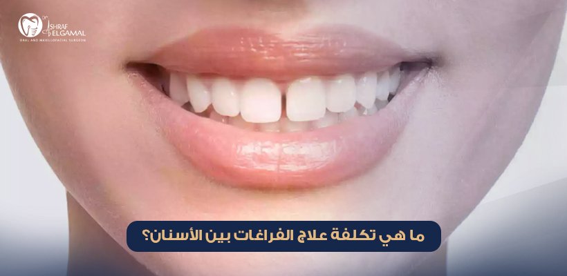 تكلفة علاج الفراغات بين الأسنان