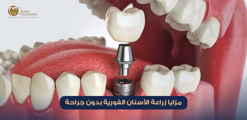 زراعة الأسنان الفورية بدون جراحة