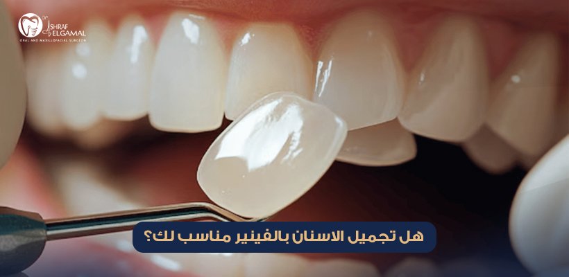 تجميل الاسنان بالفينير
