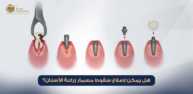 علاج سقوط مسمار زراعة الأسنان