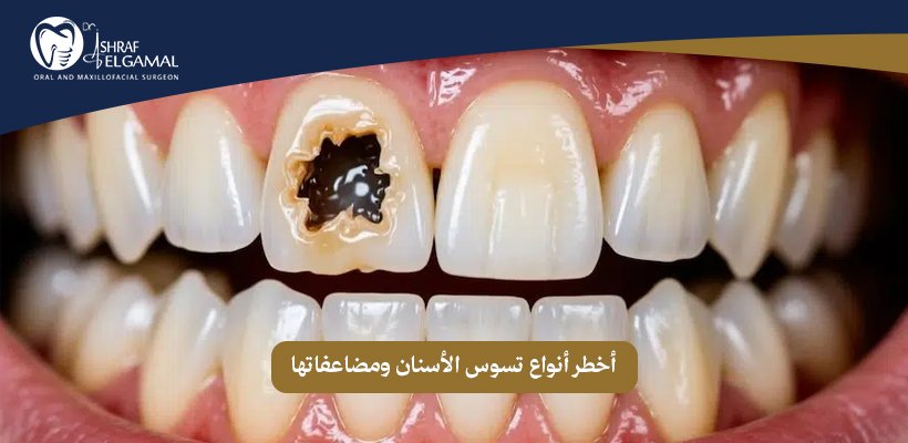 أخطر أنواع تسوس الأسنان
