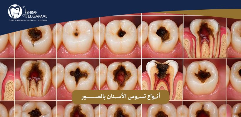 أنواع تسوس الأسنان بالصور