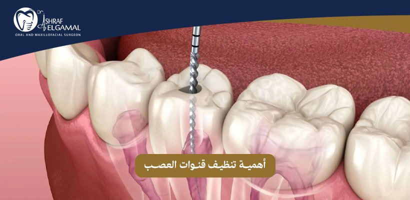 تنظيف قنوات العصب