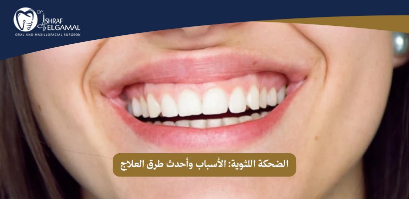 الضحكة اللثوية