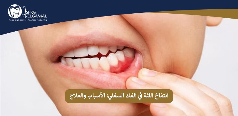 انتفاخ اللثة في الفك السفلي