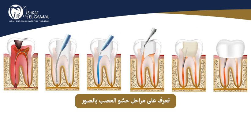 حشو العصب بالصور