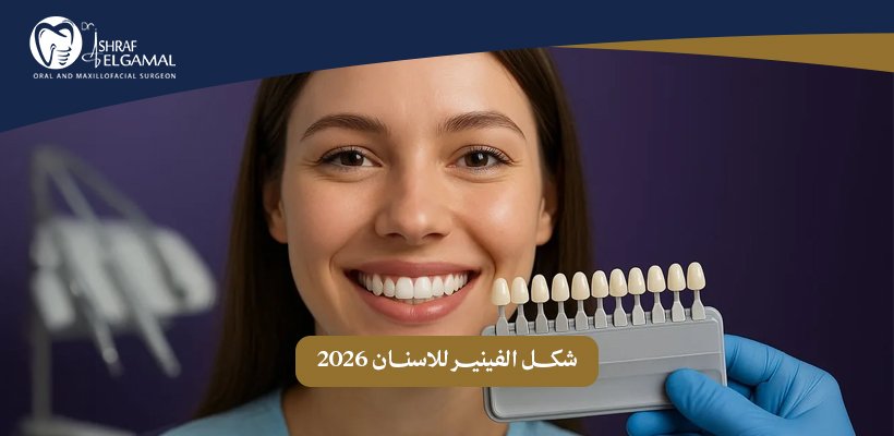 شكل الفينير للاسنان
