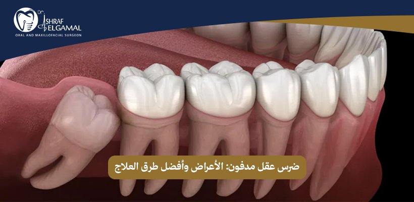 ضرس عقل مدفون