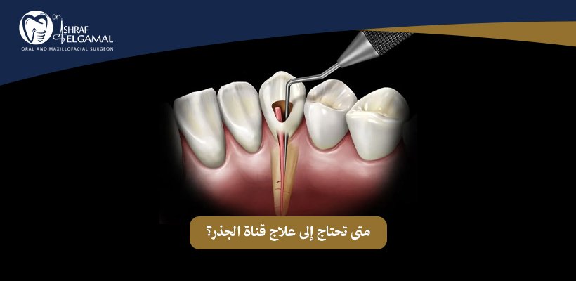 علاج قناة الجذر