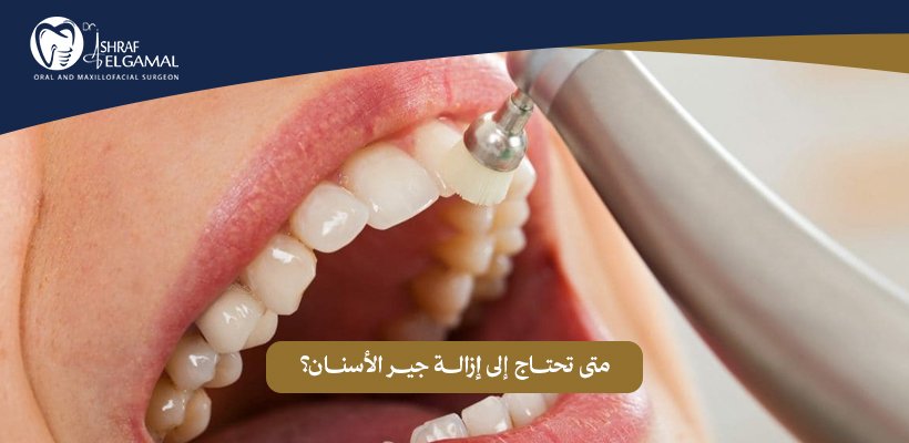 إزالة جير الأسنان
