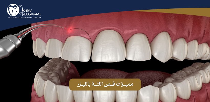 قص اللثة بالليزر