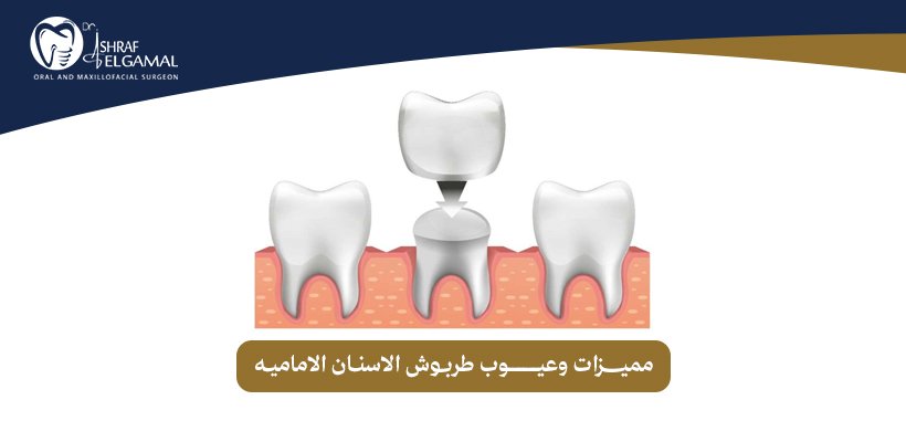 طربوش الاسنان الاماميه