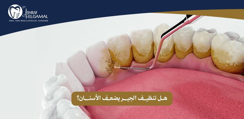 هل تنظيف الجير يضعف الأسنان
