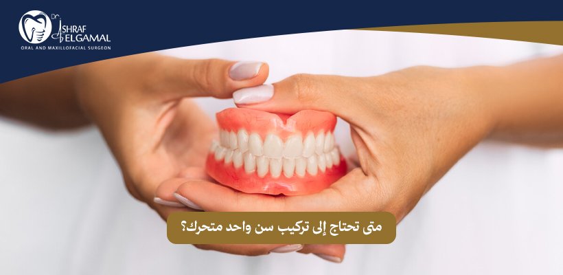 تركيب سن واحد متحرك