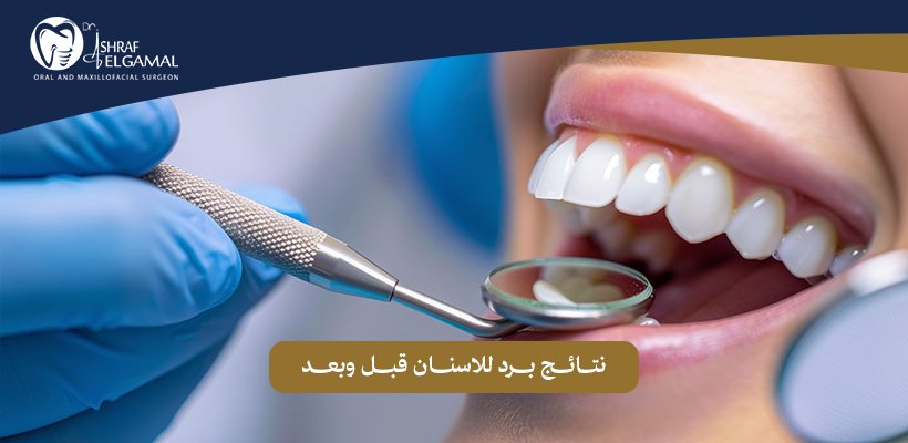برد للاسنان قبل وبعد